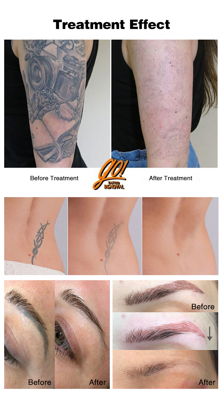 ND Yag Laser - Afbeelding 9